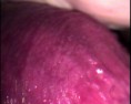 /album/lesion-en-pene-por-hpv-zona-prepucio-peneoscopia-digital/a-f-a-2010-04-21-18-02-23h-jpg/